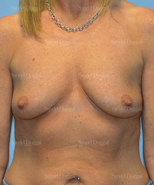 breast augmentation with lift patient