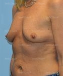 breast augmentation with lift patient