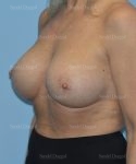breast augmentation with lift patient