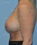 breast augmentation with lift patient
