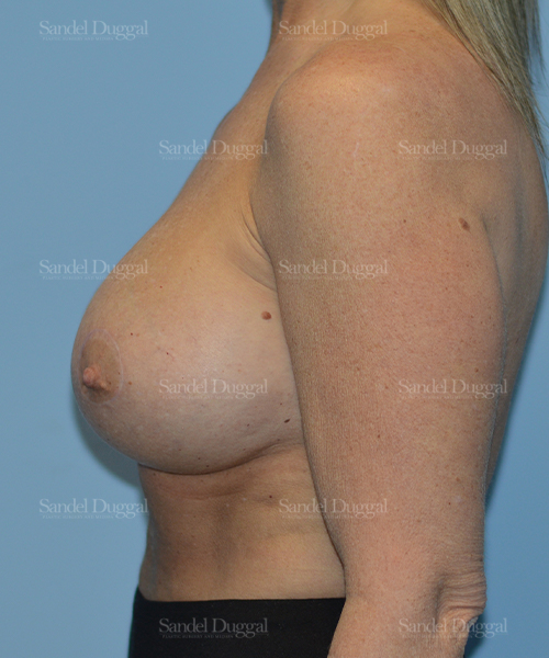 breast augmentation with lift patient