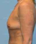 breast augmentation with lift patient