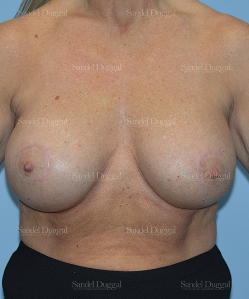 breast augmentation with lift patient