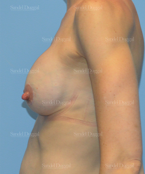 breast augmentation with lift patient