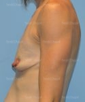 breast augmentation with lift patient