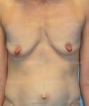 breast augmentation with lift patient