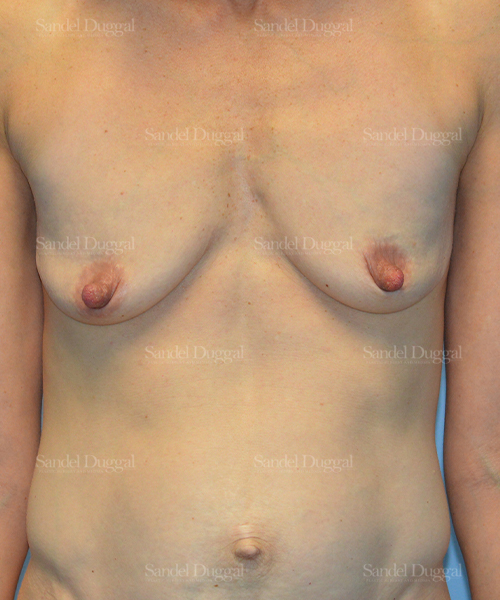 breast augmentation with lift patient