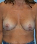 breast augmentation with lift patient