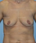 breast augmentation with lift patient
