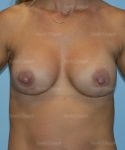 breast augmentation with lift patient