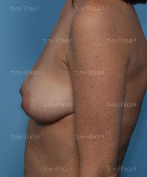 breast augmentation with lift patient