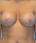breast augmentation with lift patient