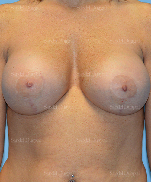 breast augmentation with lift patient