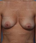 breast augmentation with lift patient