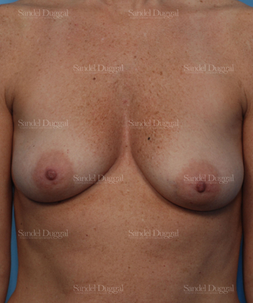 breast augmentation with lift patient