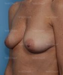 breast augmentation with lift patient
