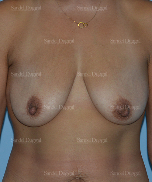 breast augmentation with lift patient