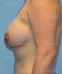 breast augmentation with lift patient