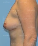 breast augmentation with lift patient