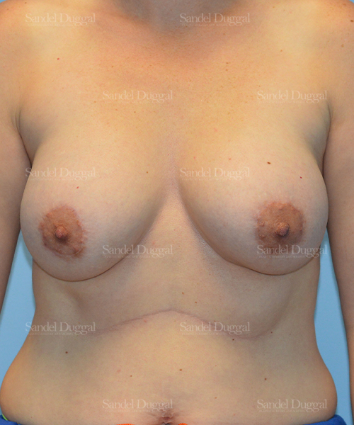 breast augmentation with lift patient