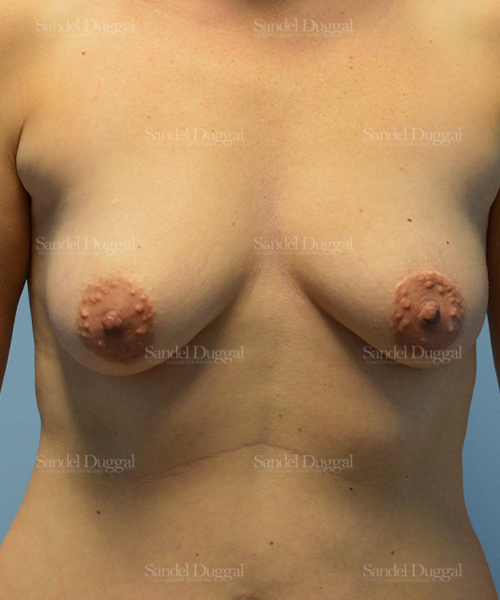 breast augmentation with lift patient
