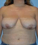 breast lift patient
