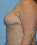 breast lift patient