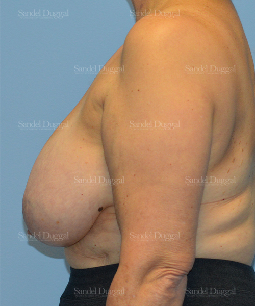 breast lift patient