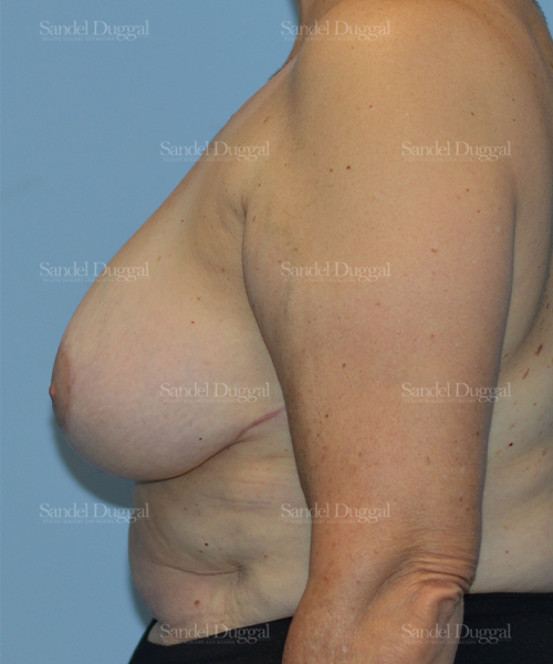 breast lift patient