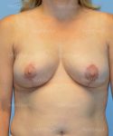 breast lift patient