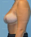 breast lift patient