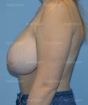 breast lift patient