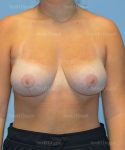 breast lift patient