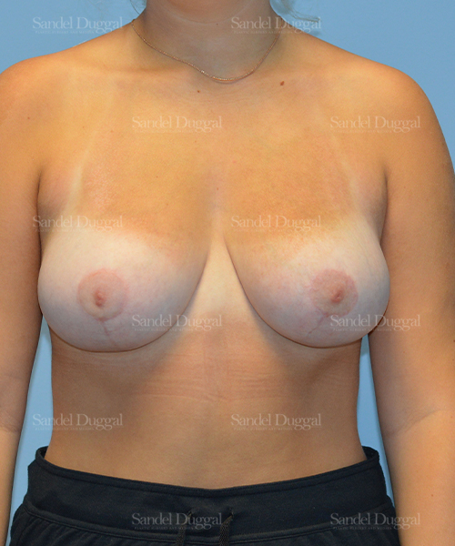 breast lift patient