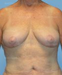breast lift patient