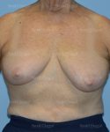 breast lift patient