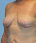 breast lift patient