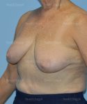 breast lift patient