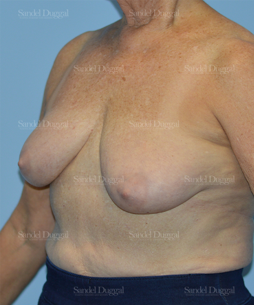 breast lift patient