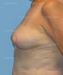 breast lift patient