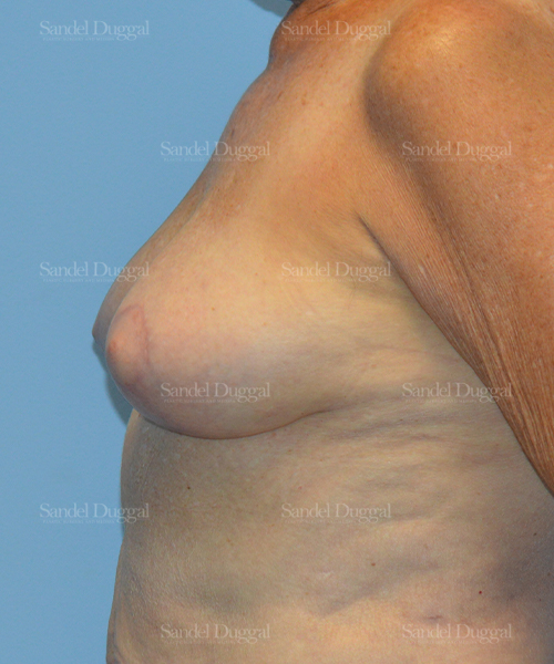 breast lift patient