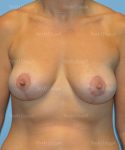 breast lift patient