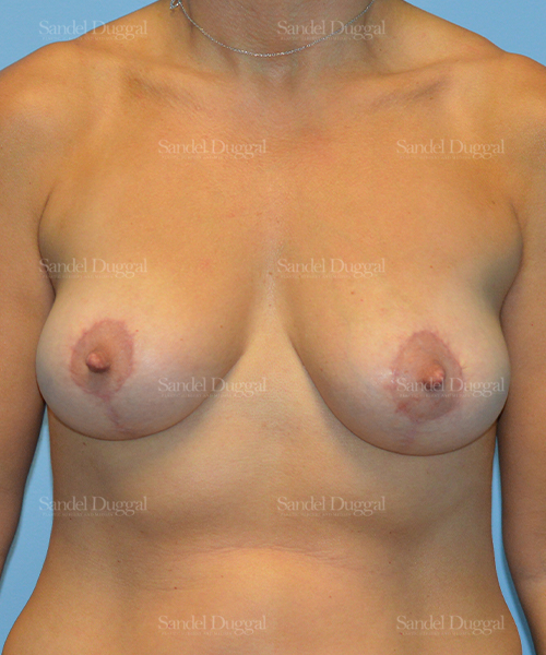 breast lift patient
