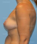breast lift patient