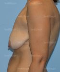 breast lift patient
