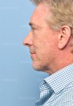 facelift patient