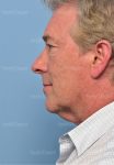 facelift patient