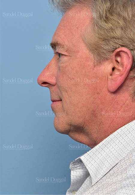 facelift patient