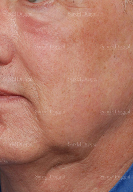 laser skin resurfacing patient