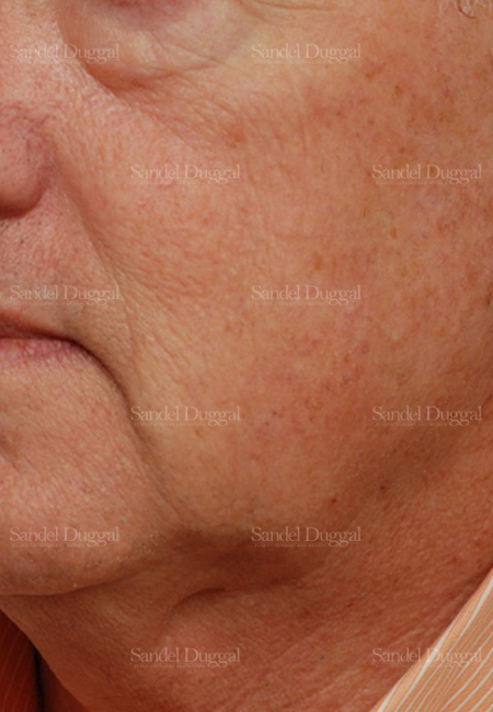 laser skin resurfacing patient